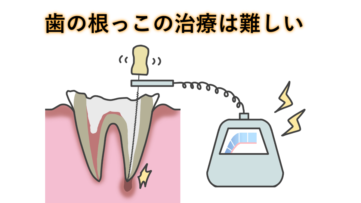 根っこの歯の治療は上手な歯医者さんで