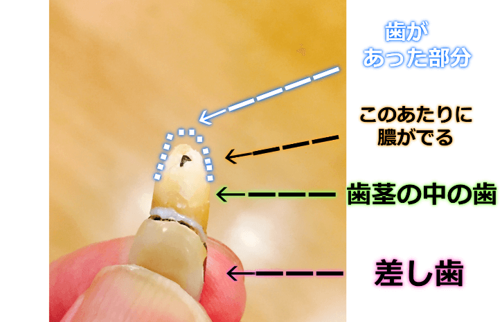 根管端切除